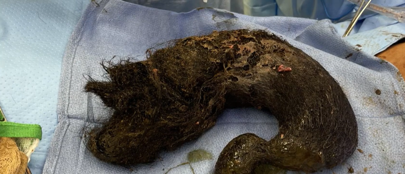 Chirurgii îndepărtează o minge de păr de 3 kg după ce o adolescentă și-a smuls aproape tot părul și l-a mâncat